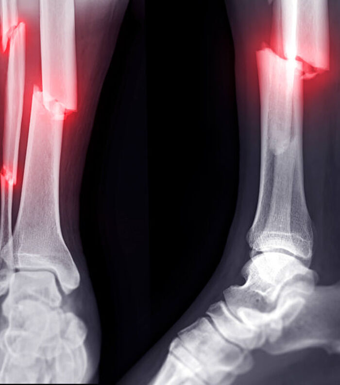 Exploring bone fracture healing with mechanomics